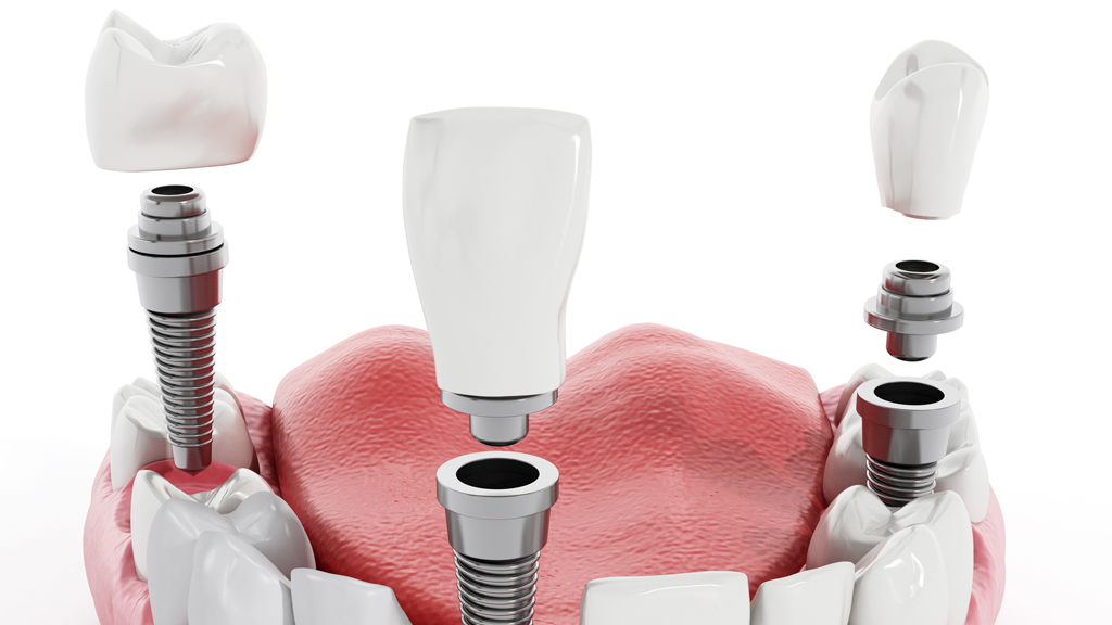Implant Bridge Denture