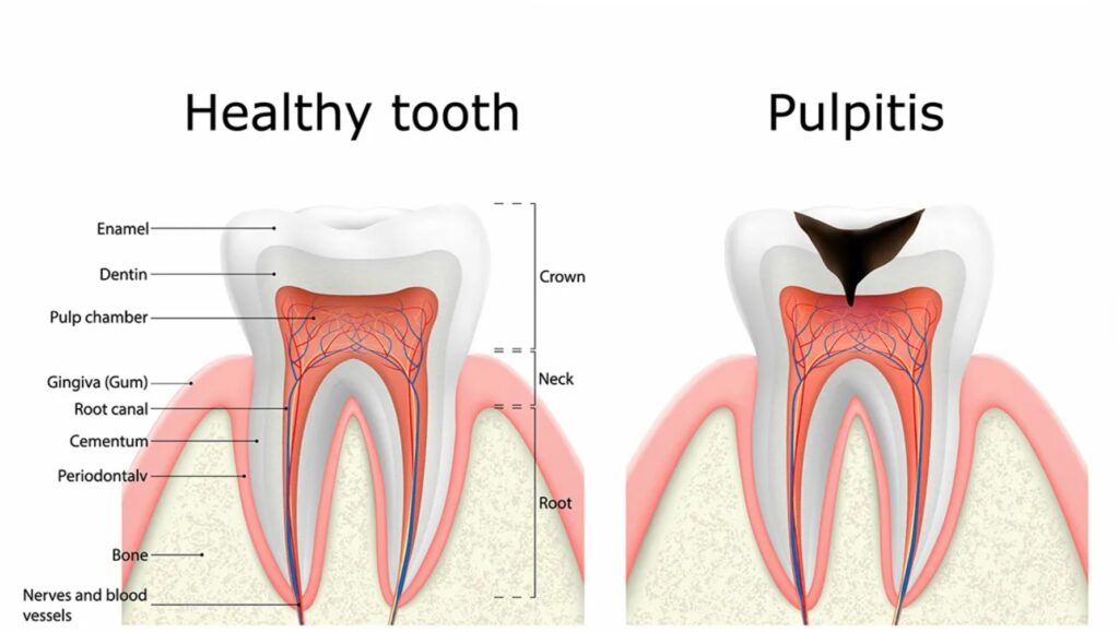 comparison of healthy tooth with nerves blood vessels vs tooth with pulpitis