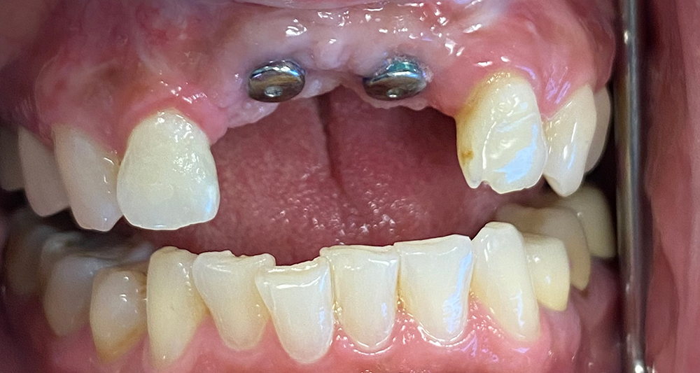 Before